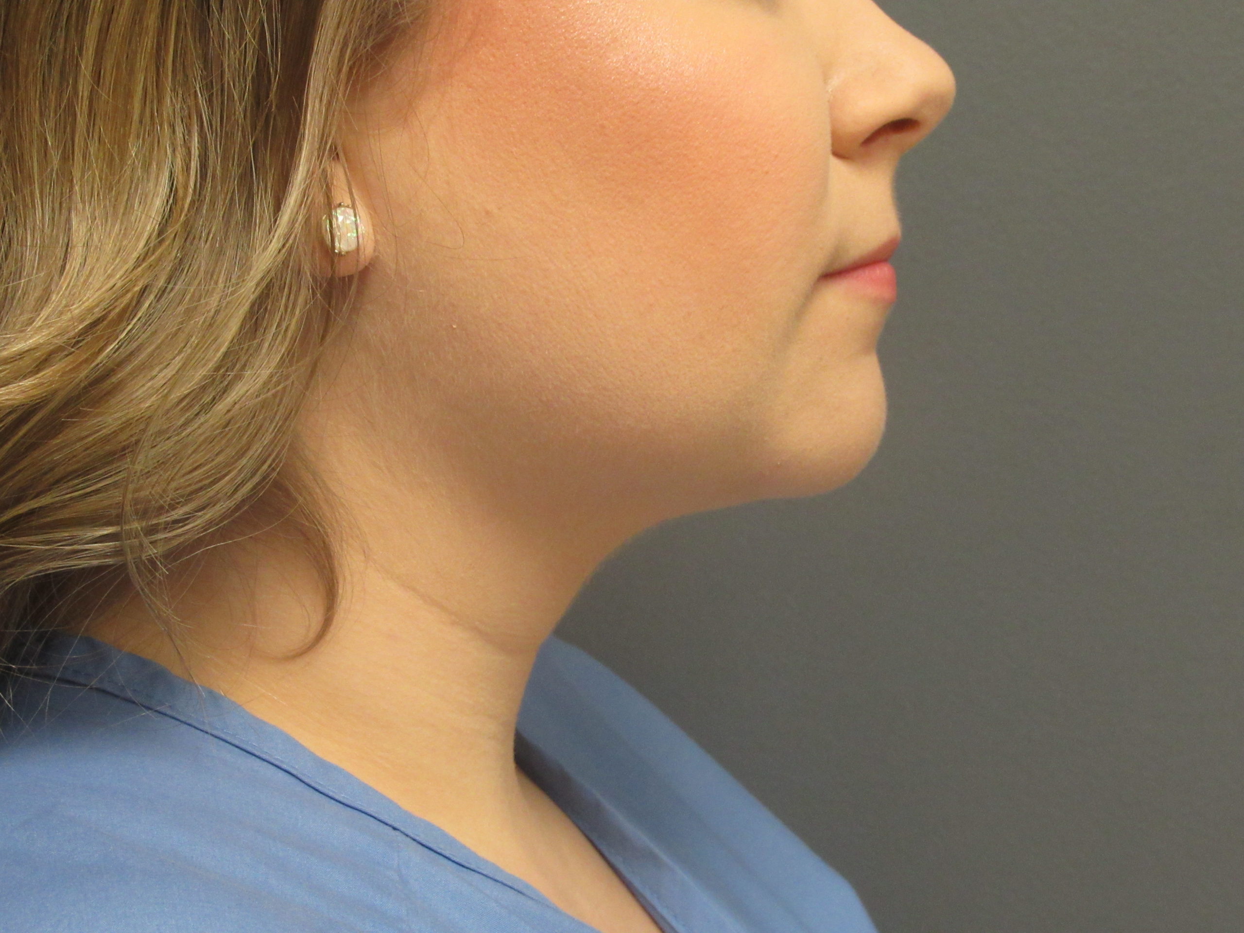 vaser liposuction of chin after