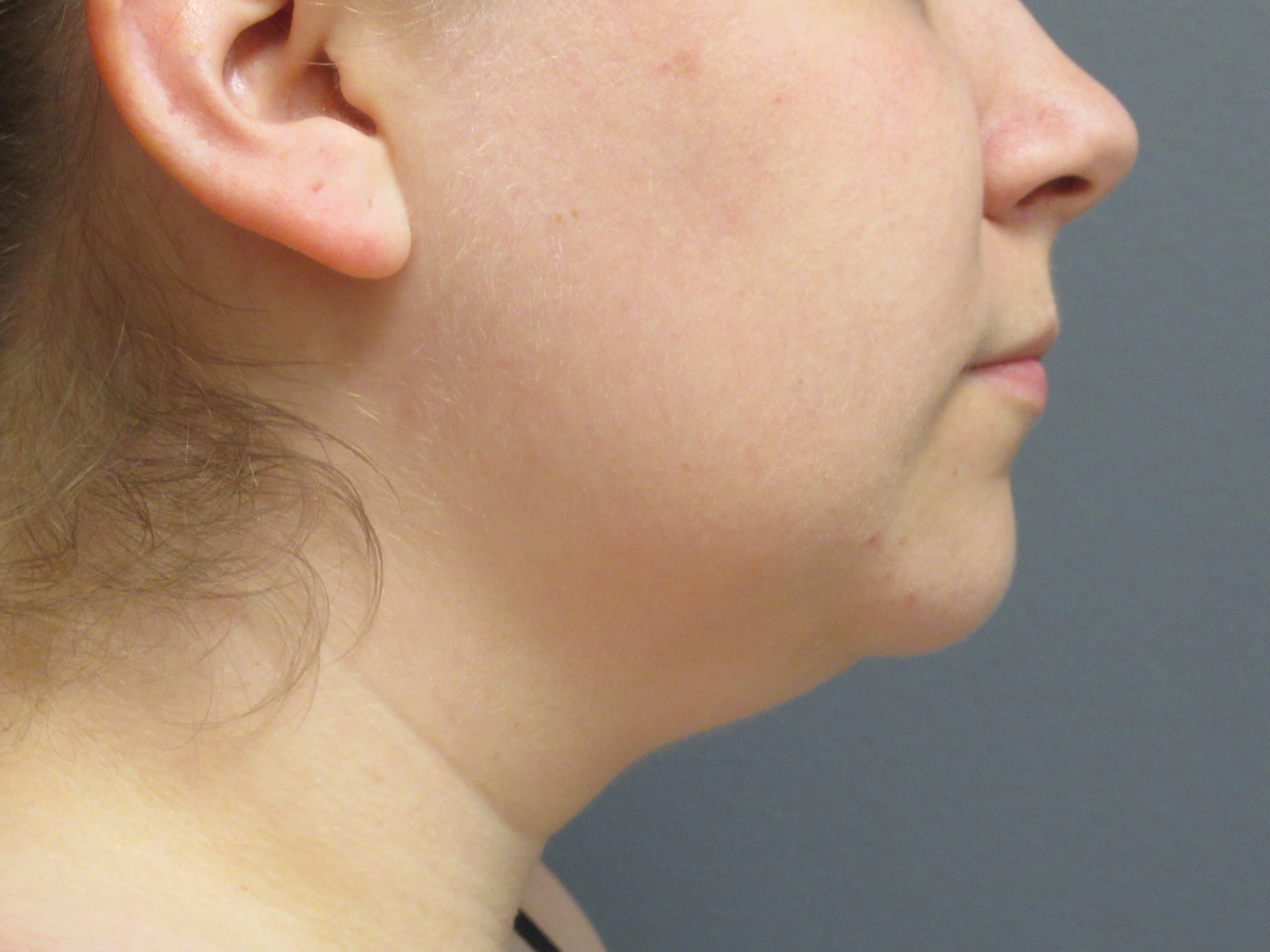 vaser liposuction of chin before