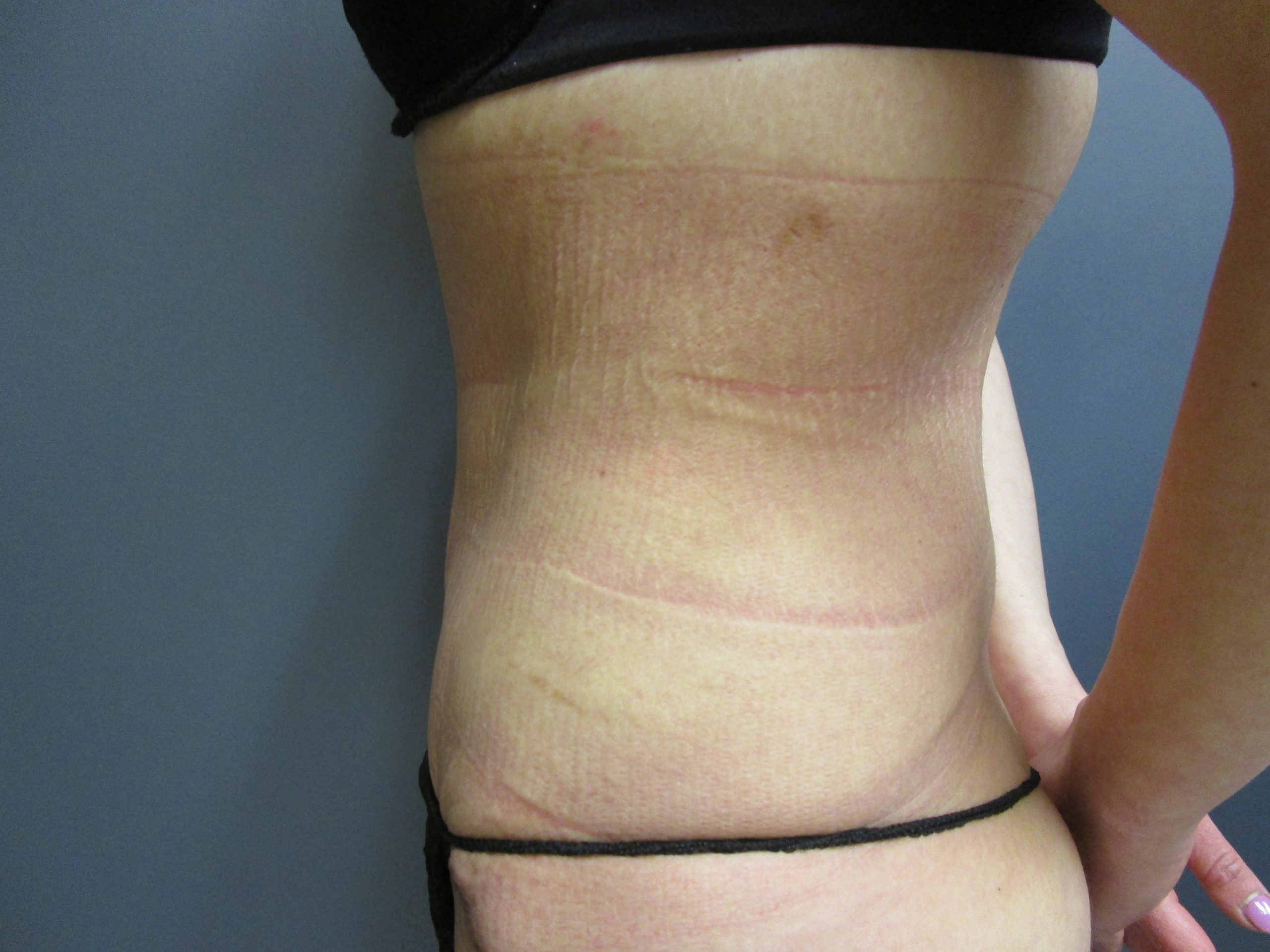 after panniculectomy and liposuction