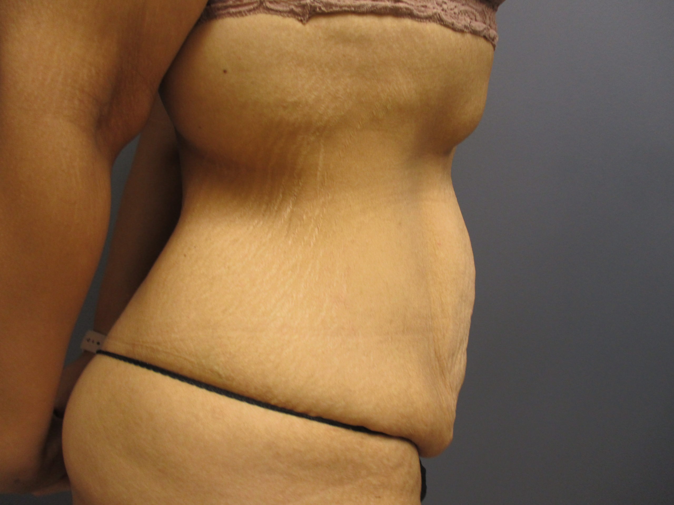 before extended panniculectomy with liposuction