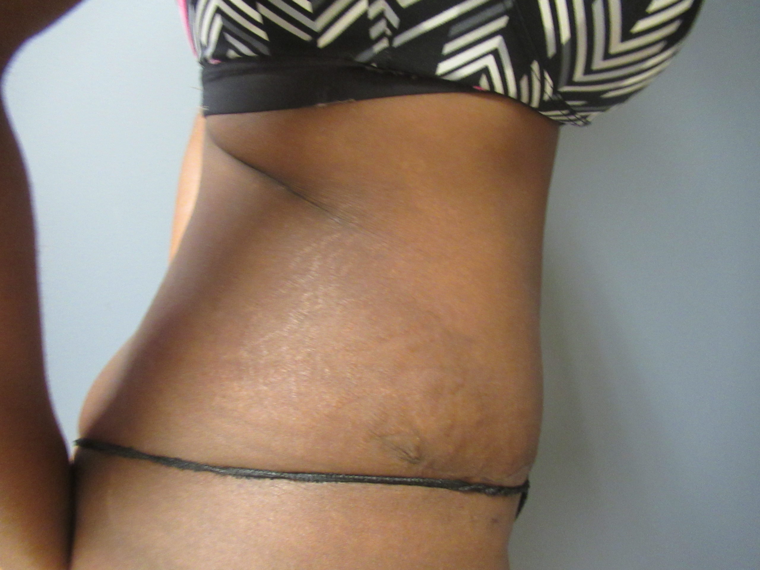 after extended panniculectomy with liposuction