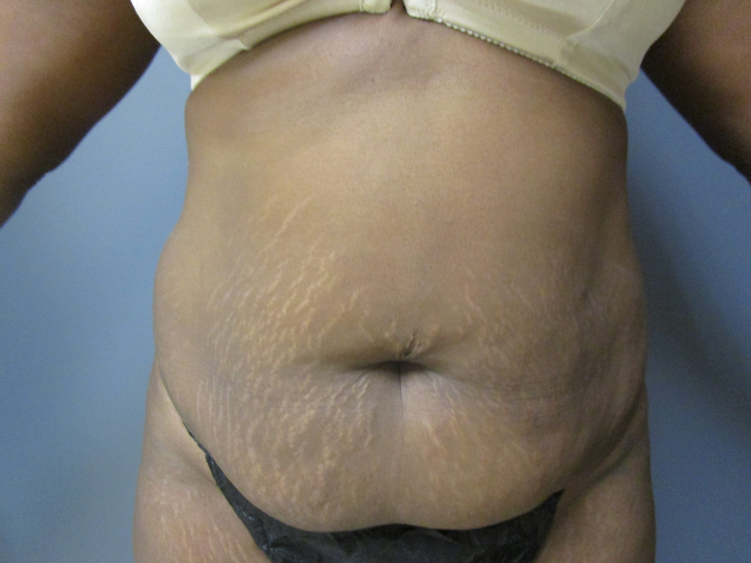 before extended panniculectomy with liposuction