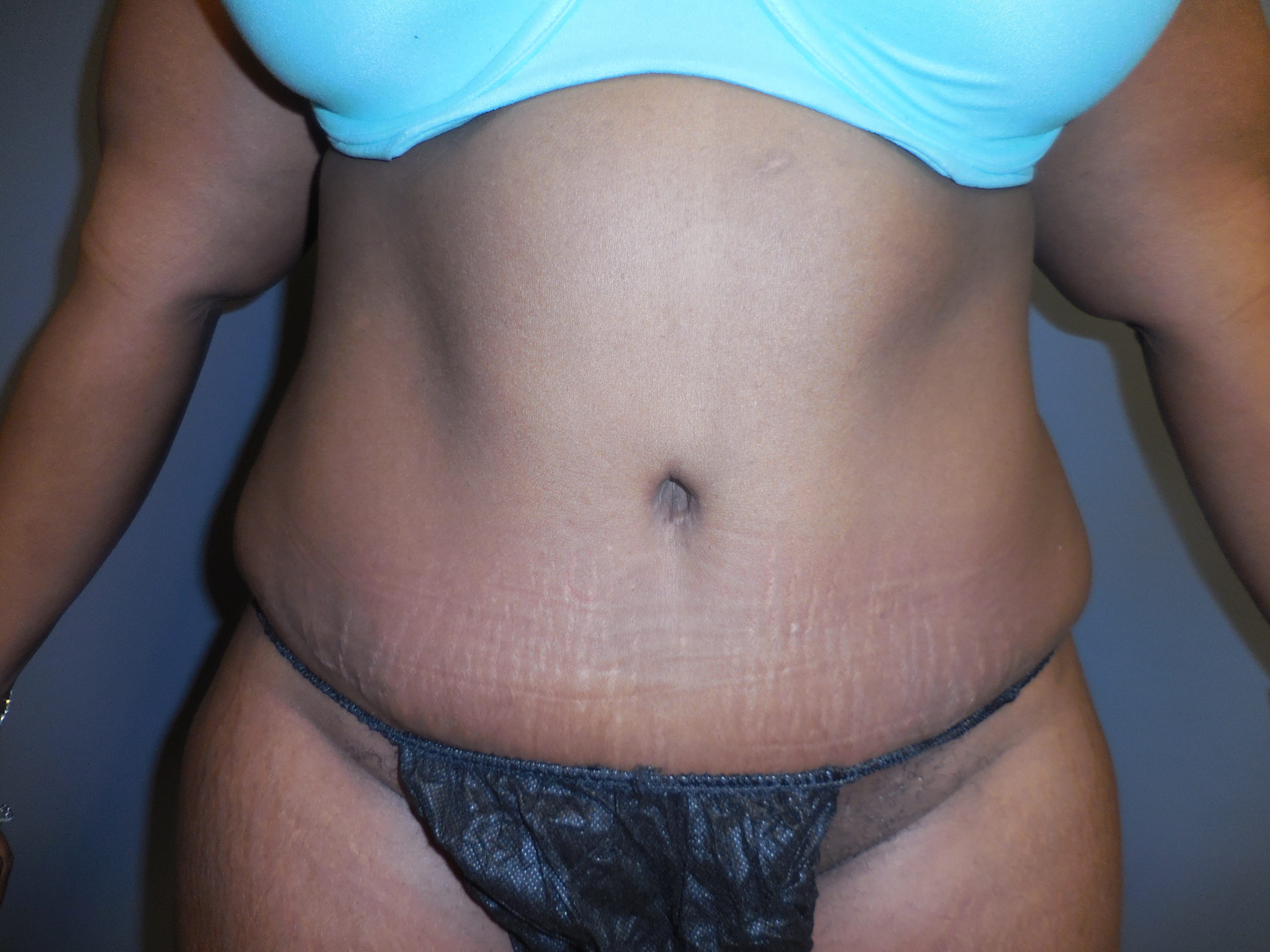 after tummy tuck front