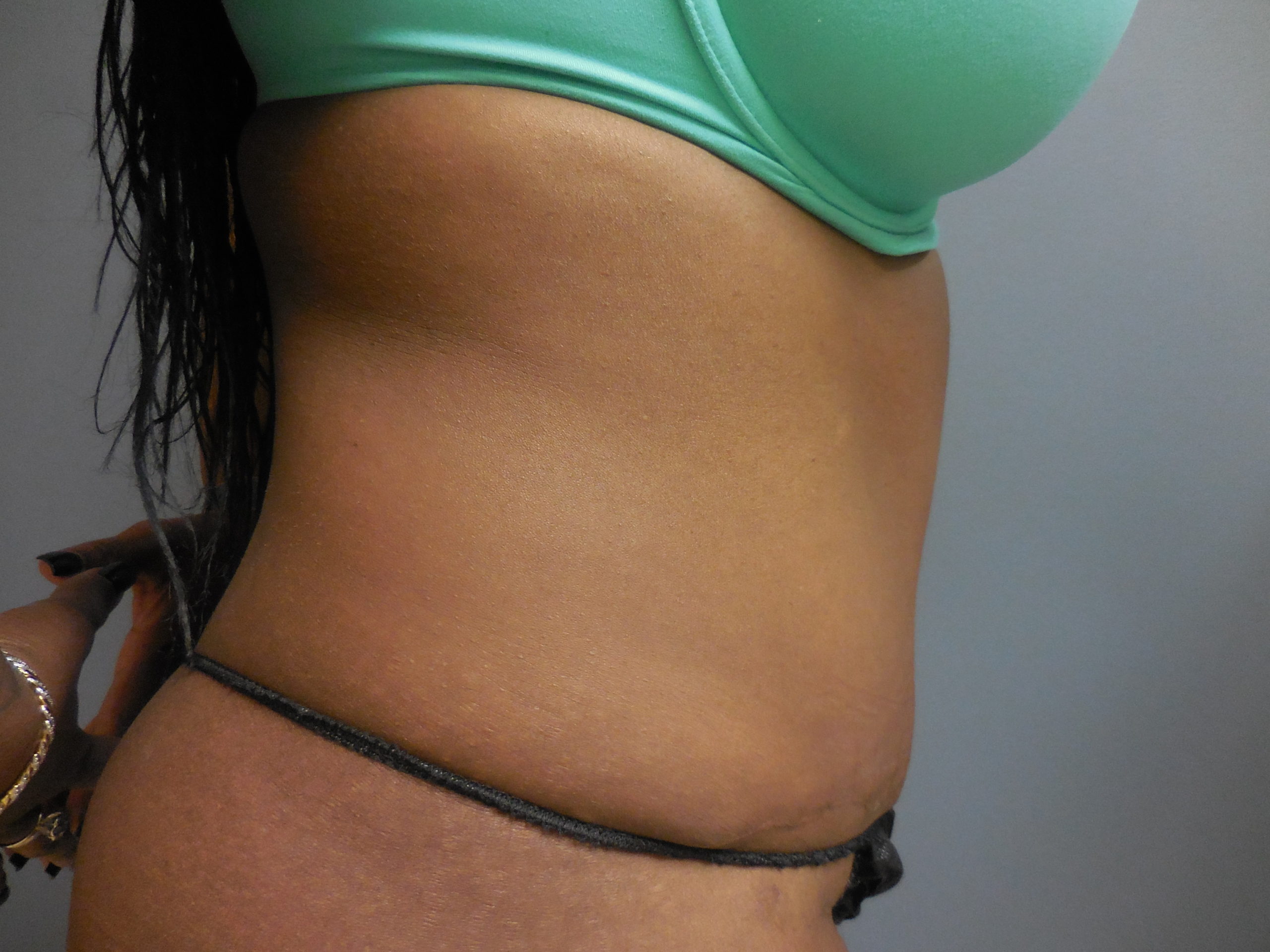 after tummy tuck side