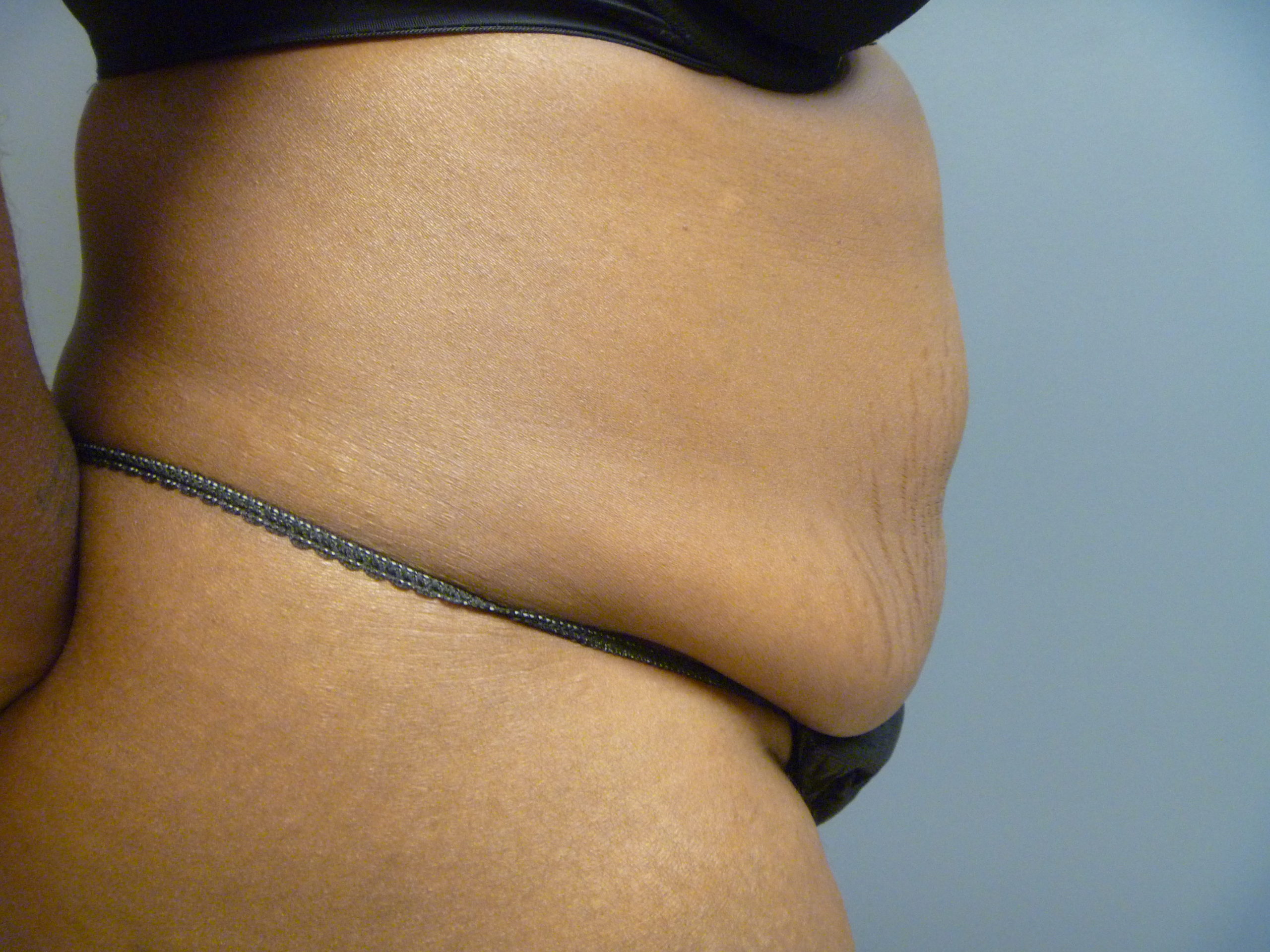 before tummy tuck side