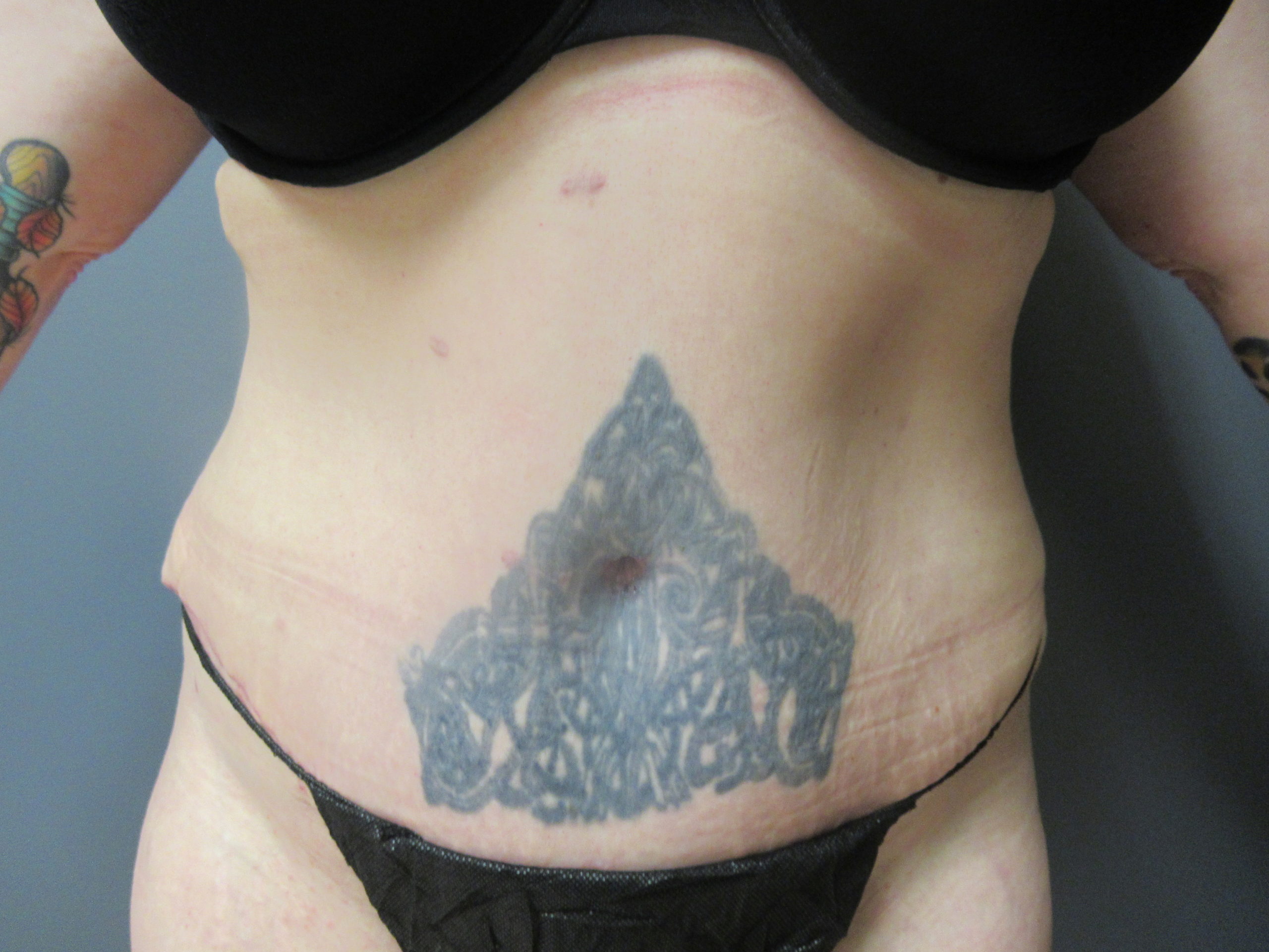 after tummy tuck