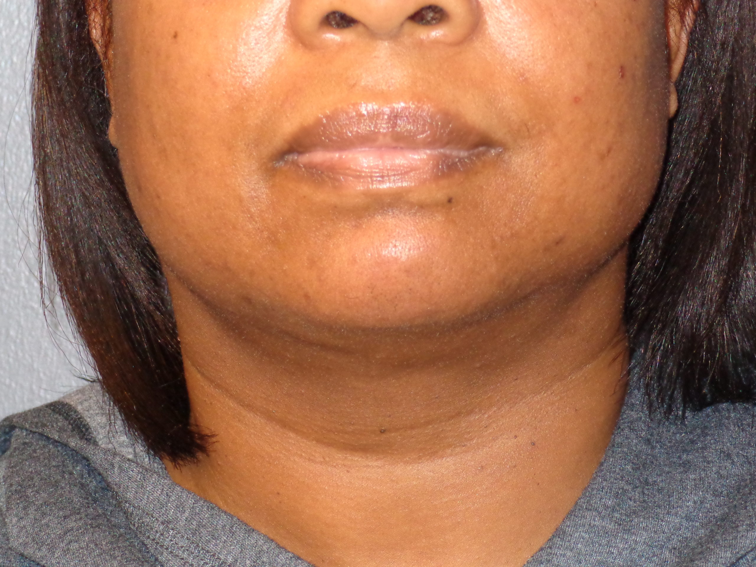 vaser liposuction of chin after