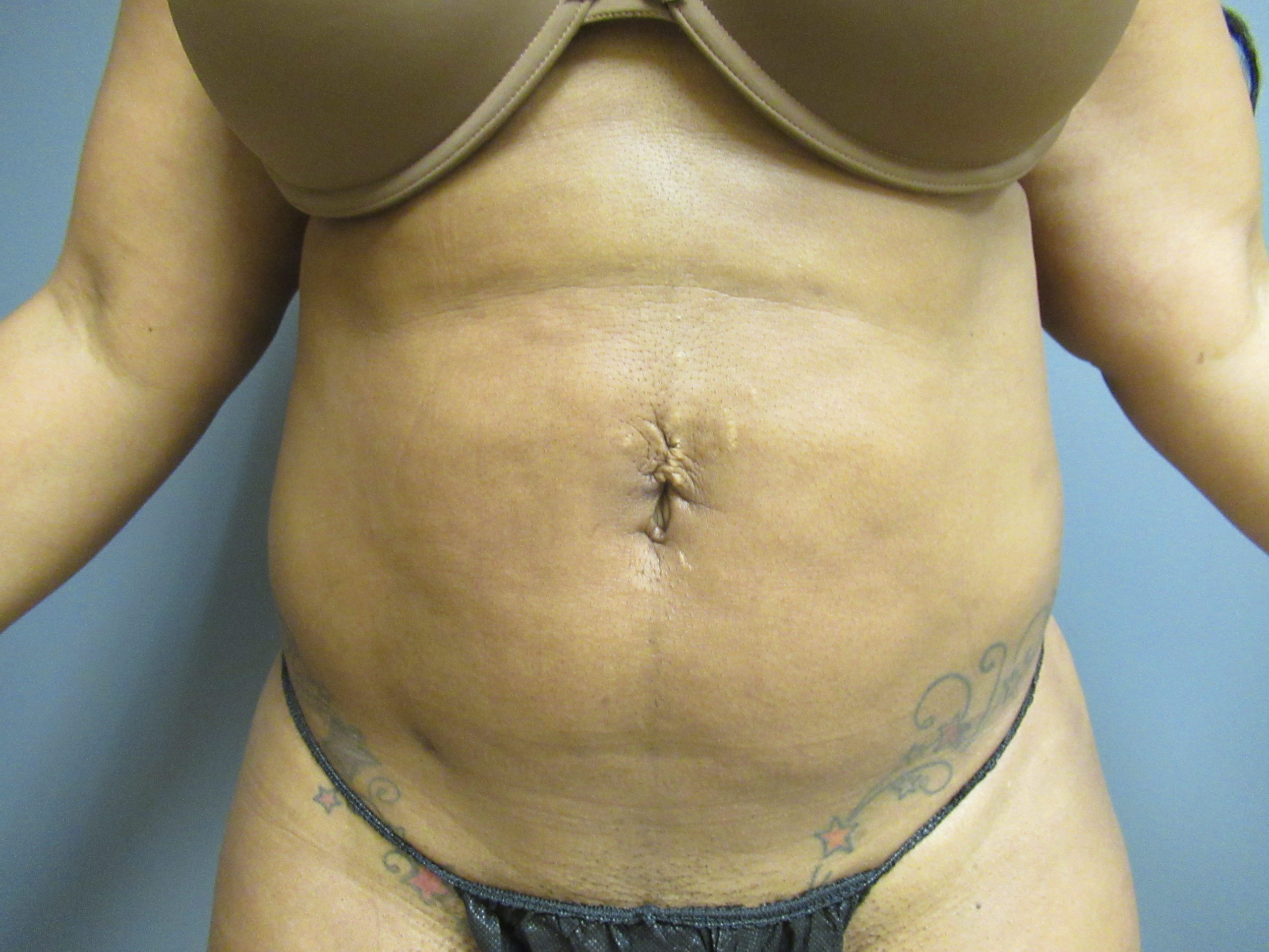 front abdomen after liposuction