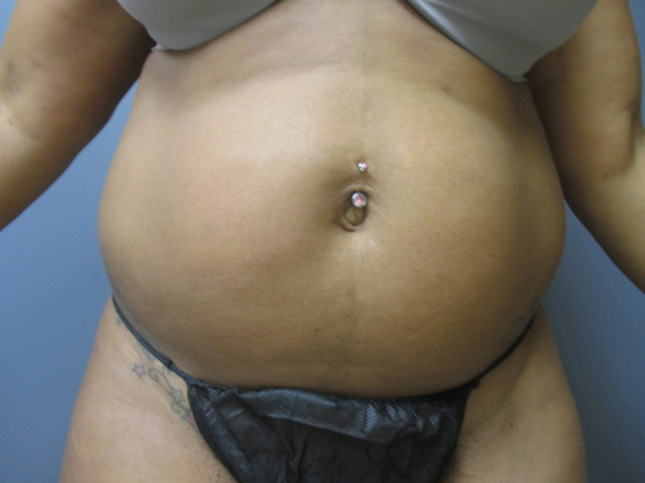 front abdomen before liposuction