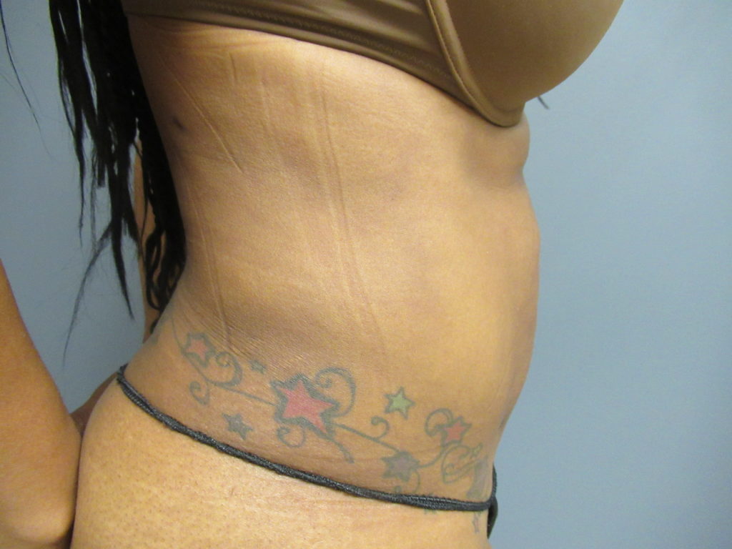 side abdomen after liposuction after