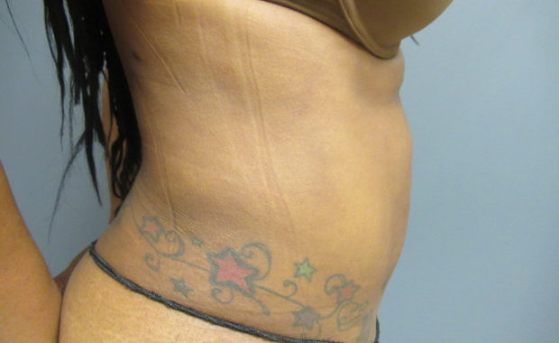 side abdomen after liposuction after
