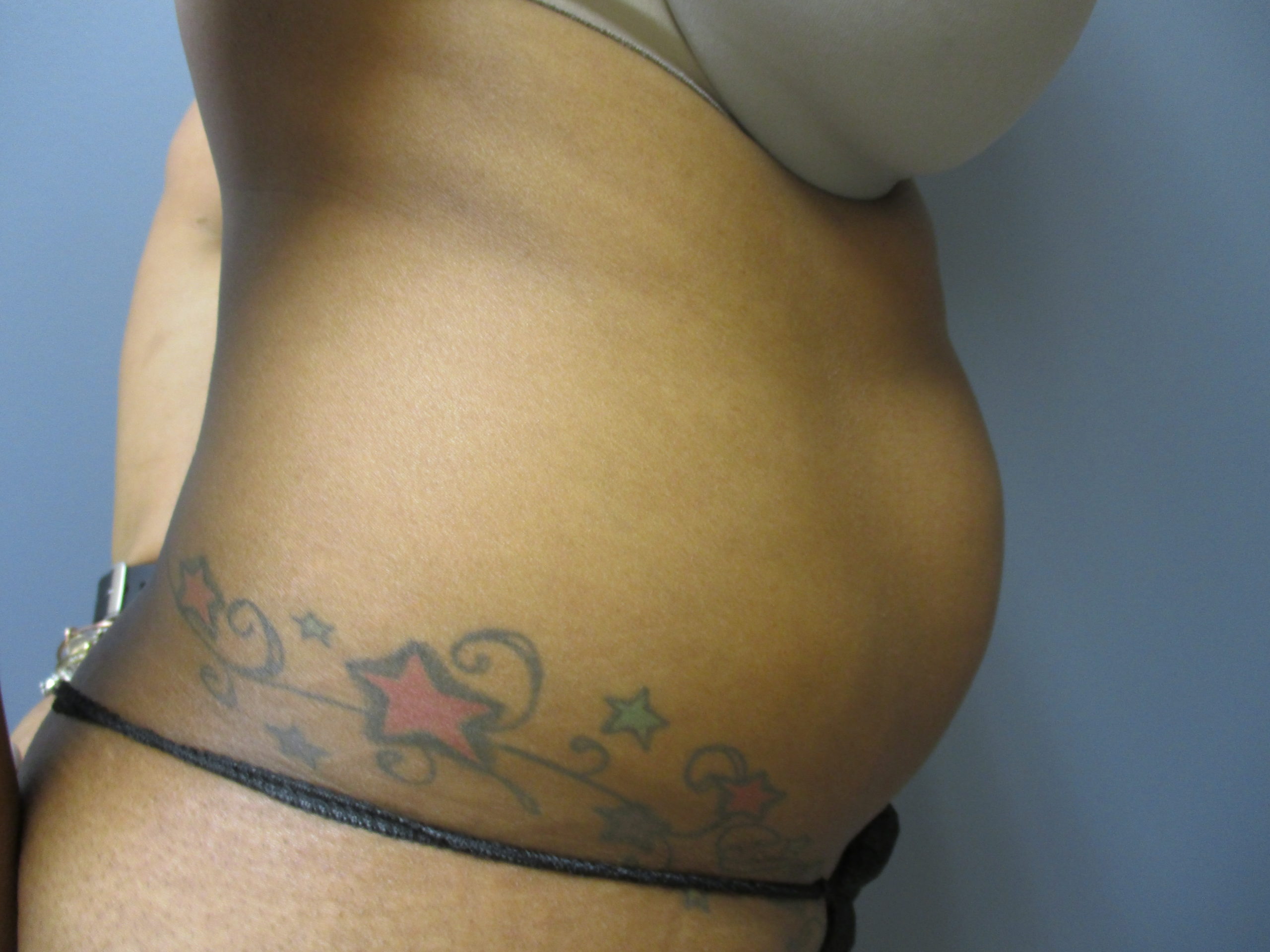 side abdomen before liposuction before