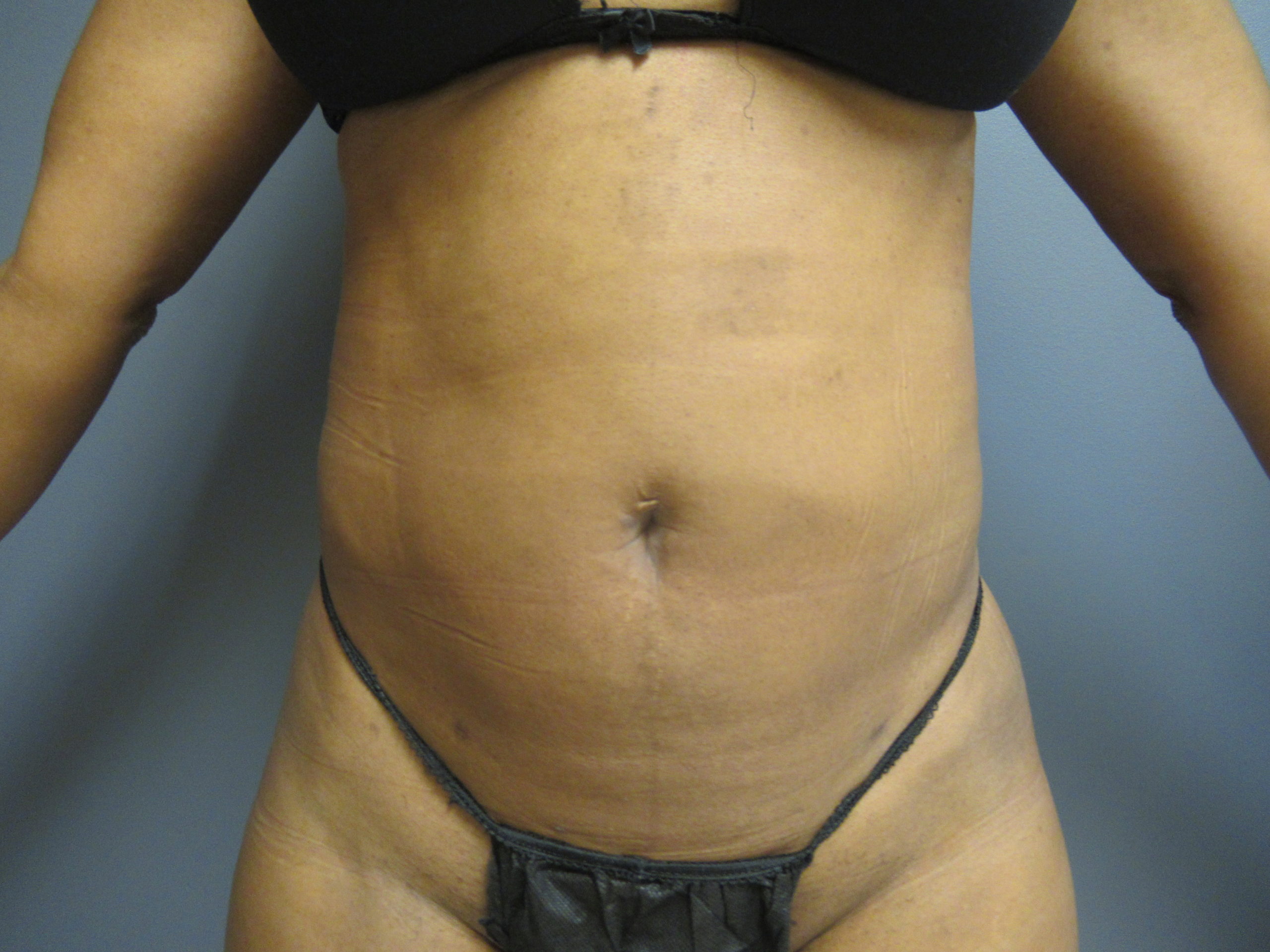 abdomen vaser liposuction after