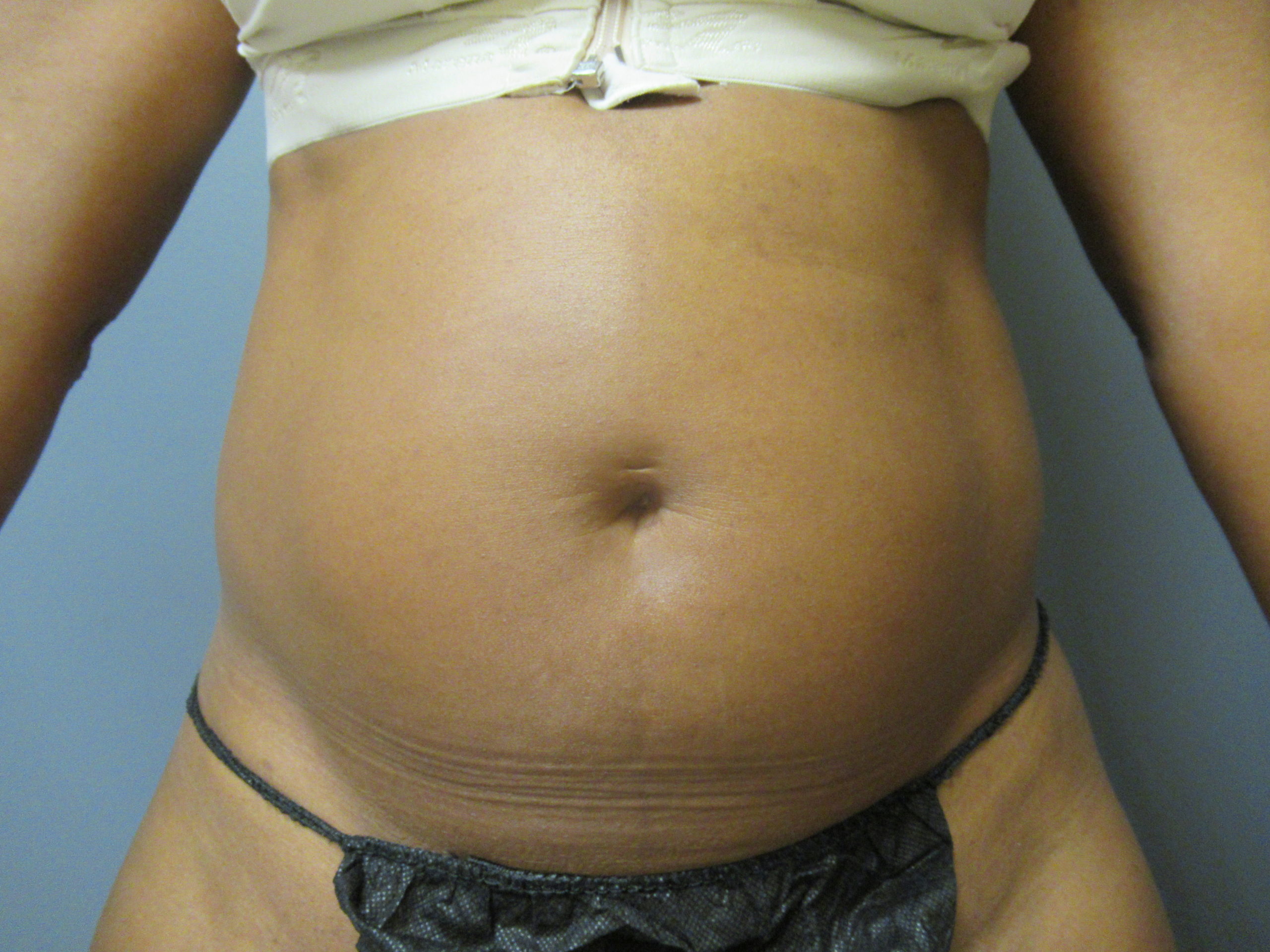 abdomen vaser liposuction