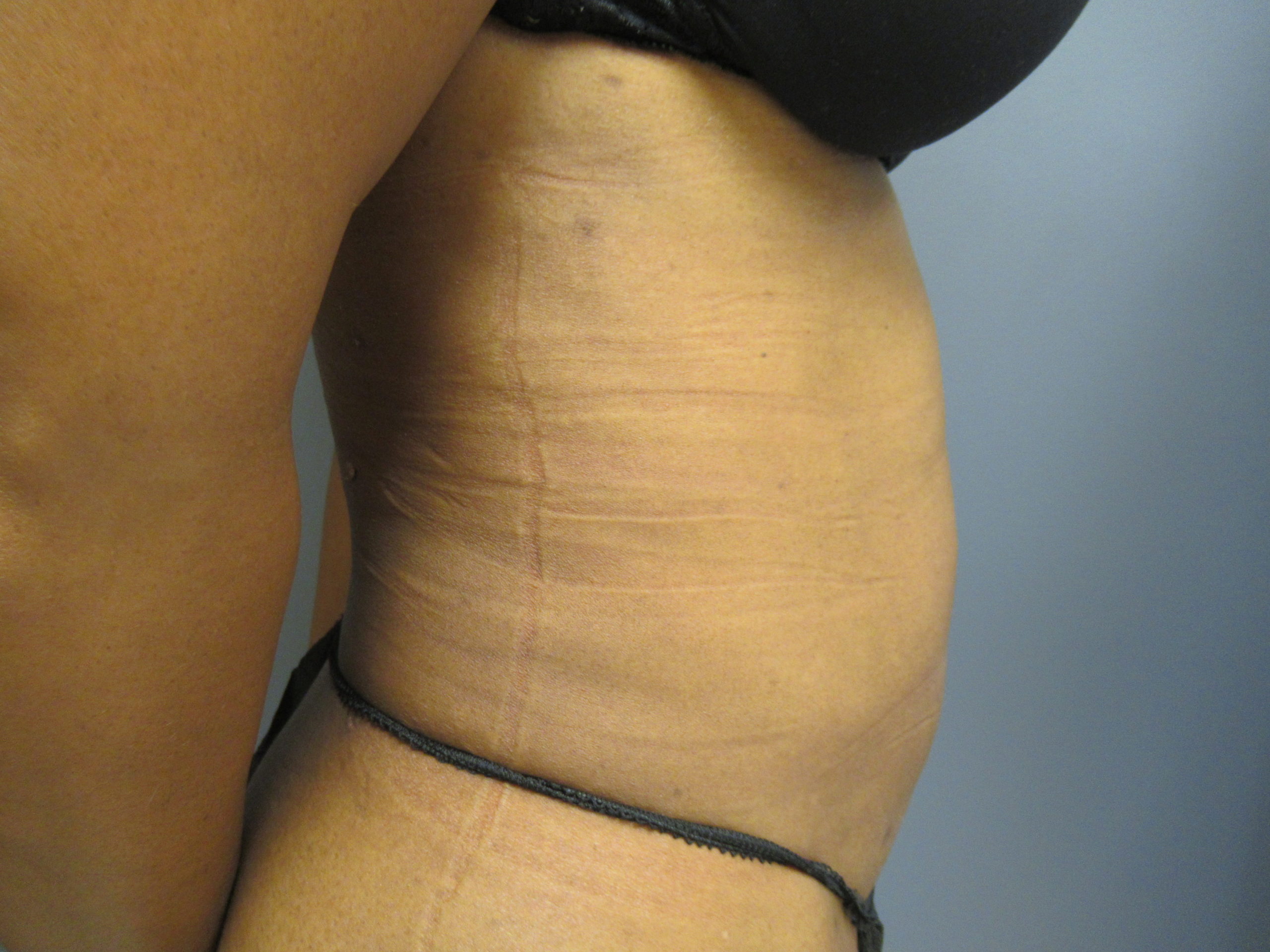abdomen vaser liposuction after