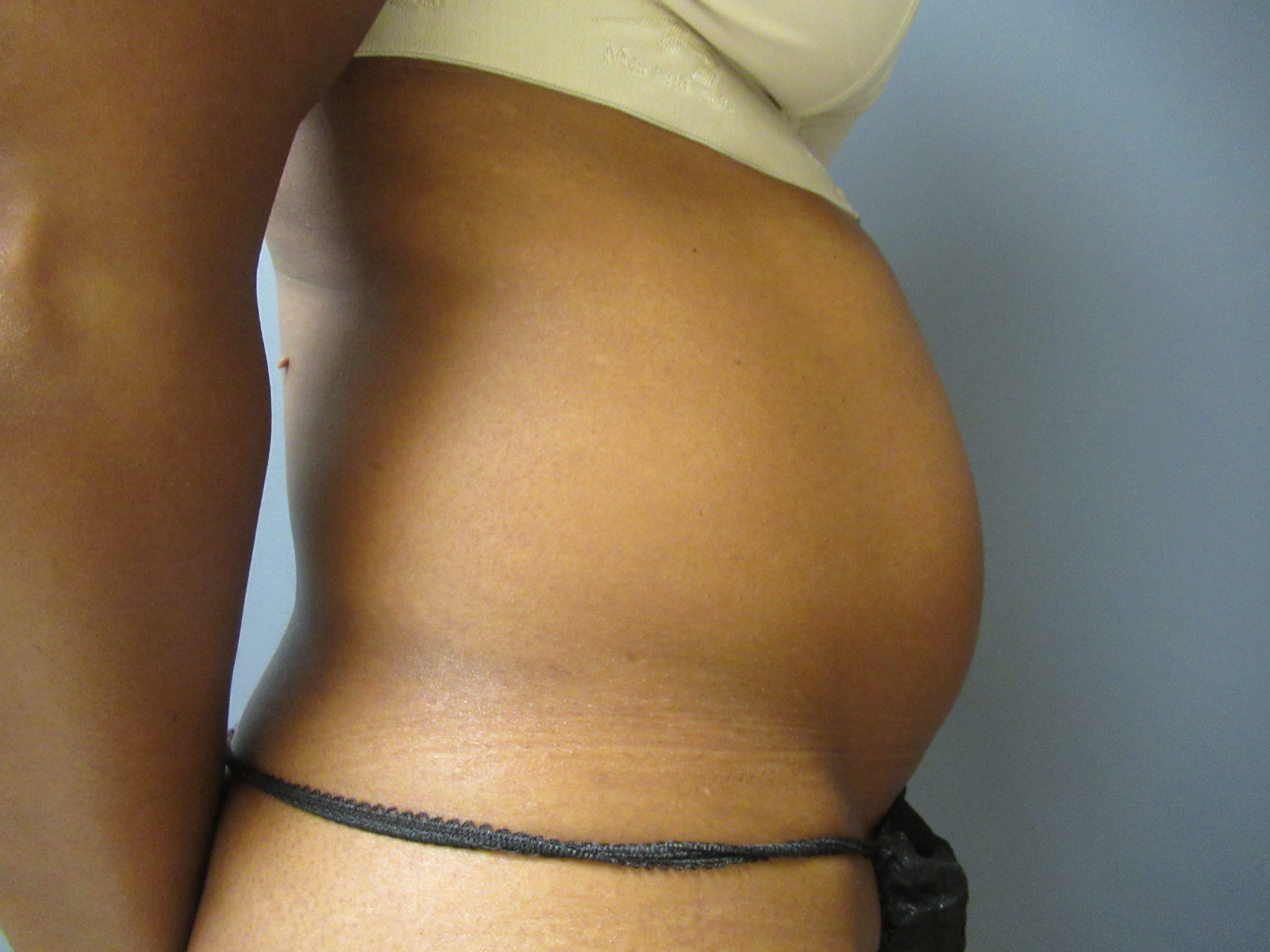 abdomen vaser liposuction before