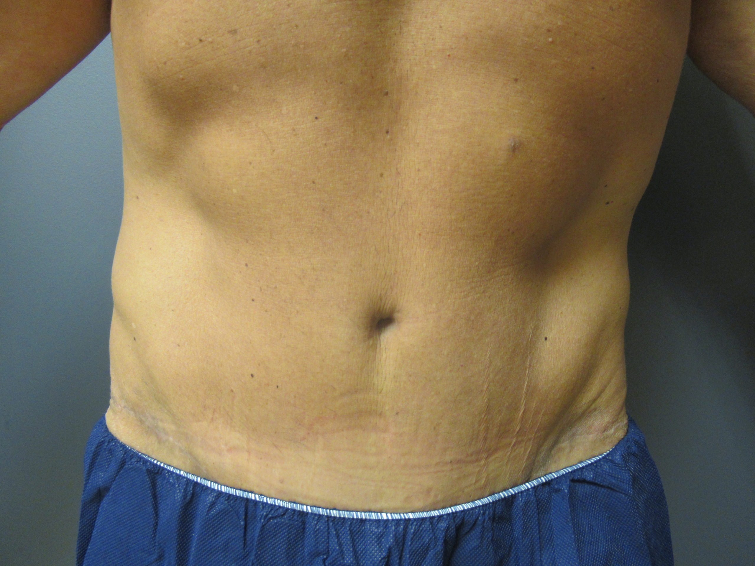 after Panniculectomy and liposuction