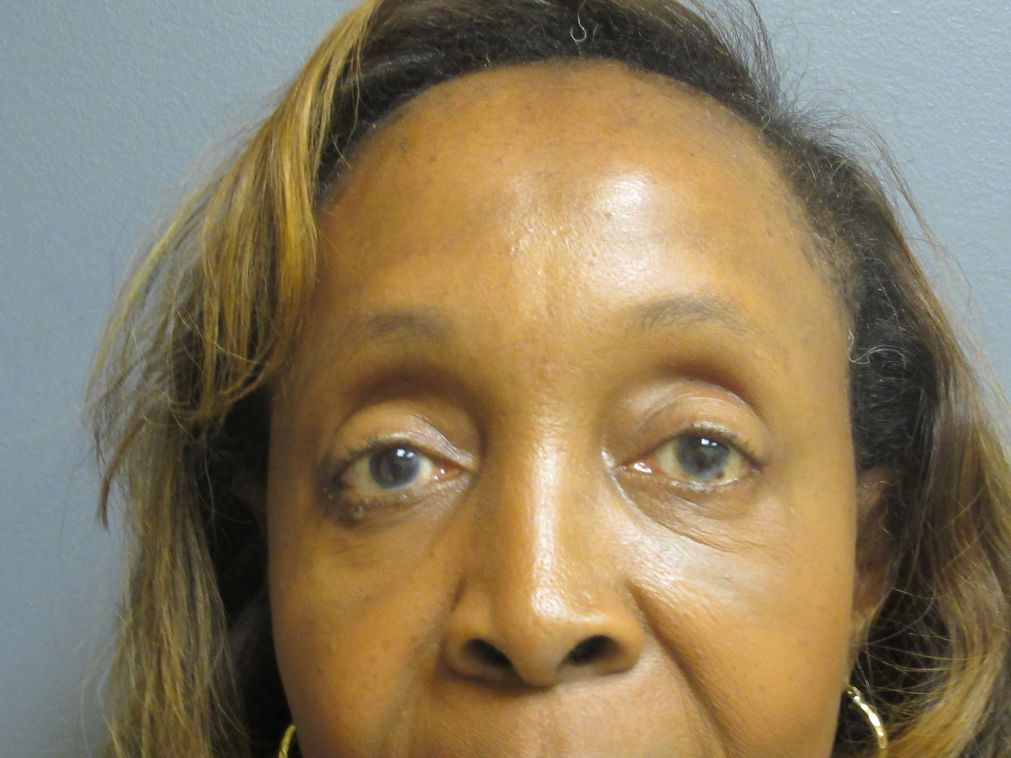 Fat Transfer Brow Lift Aesthetic Plastic Surgery & Laser Center