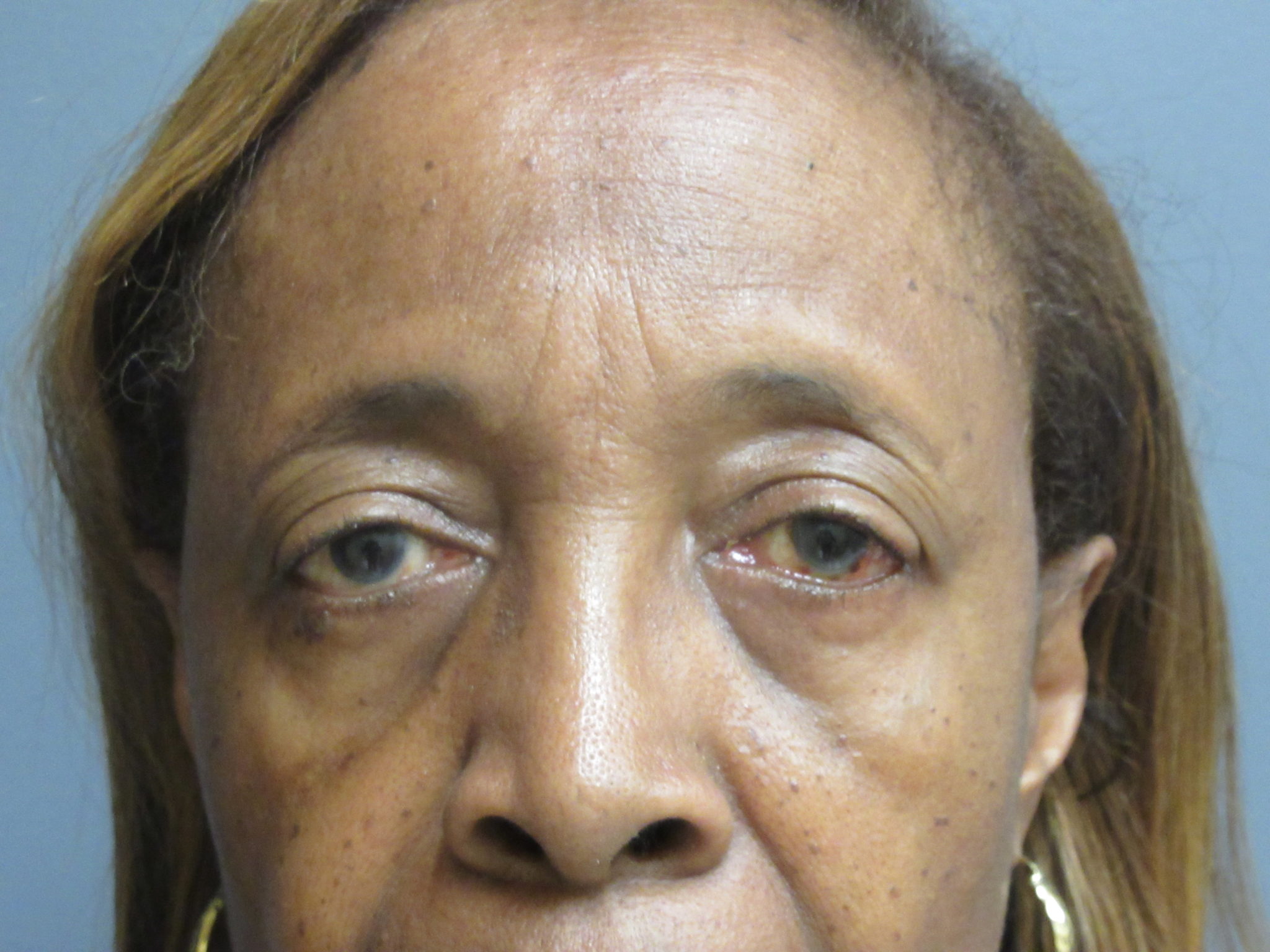 Fat Transfer Brow Lift Aesthetic Plastic Surgery & Laser Center