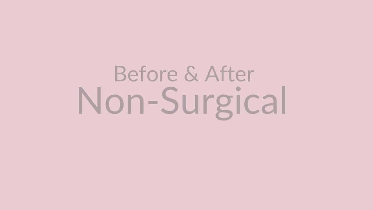 Before & After Gallery Aesthetic Plastic Surgery and Laser Center