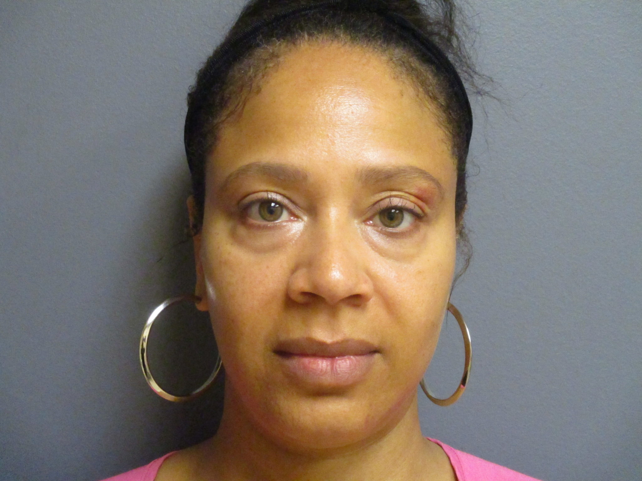 Eyelid Surgery Aesthetic Plastic Surgery & Laser Center, Michelle