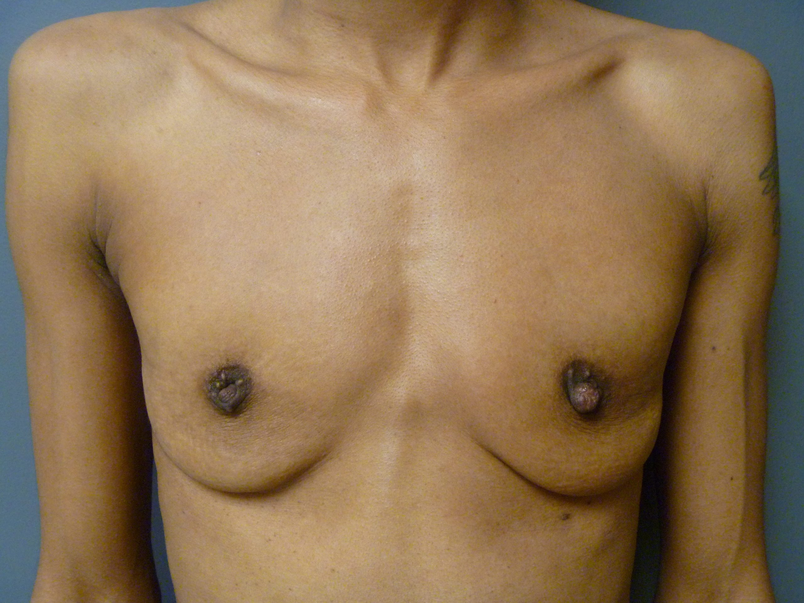 before silicone breast implants