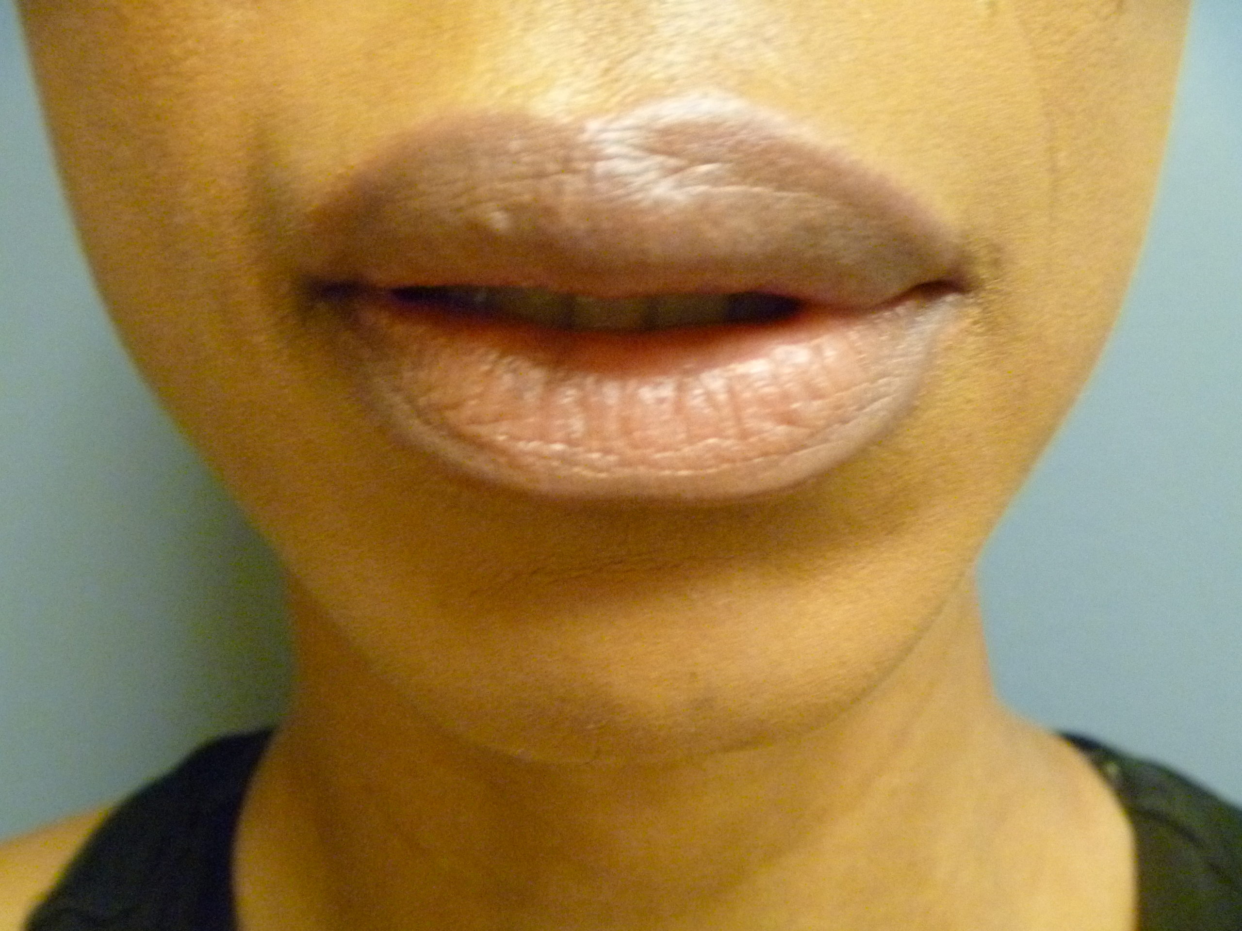after juvederm with upper lip regularity