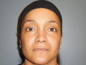 after blepharoplasty eyelid surgery
