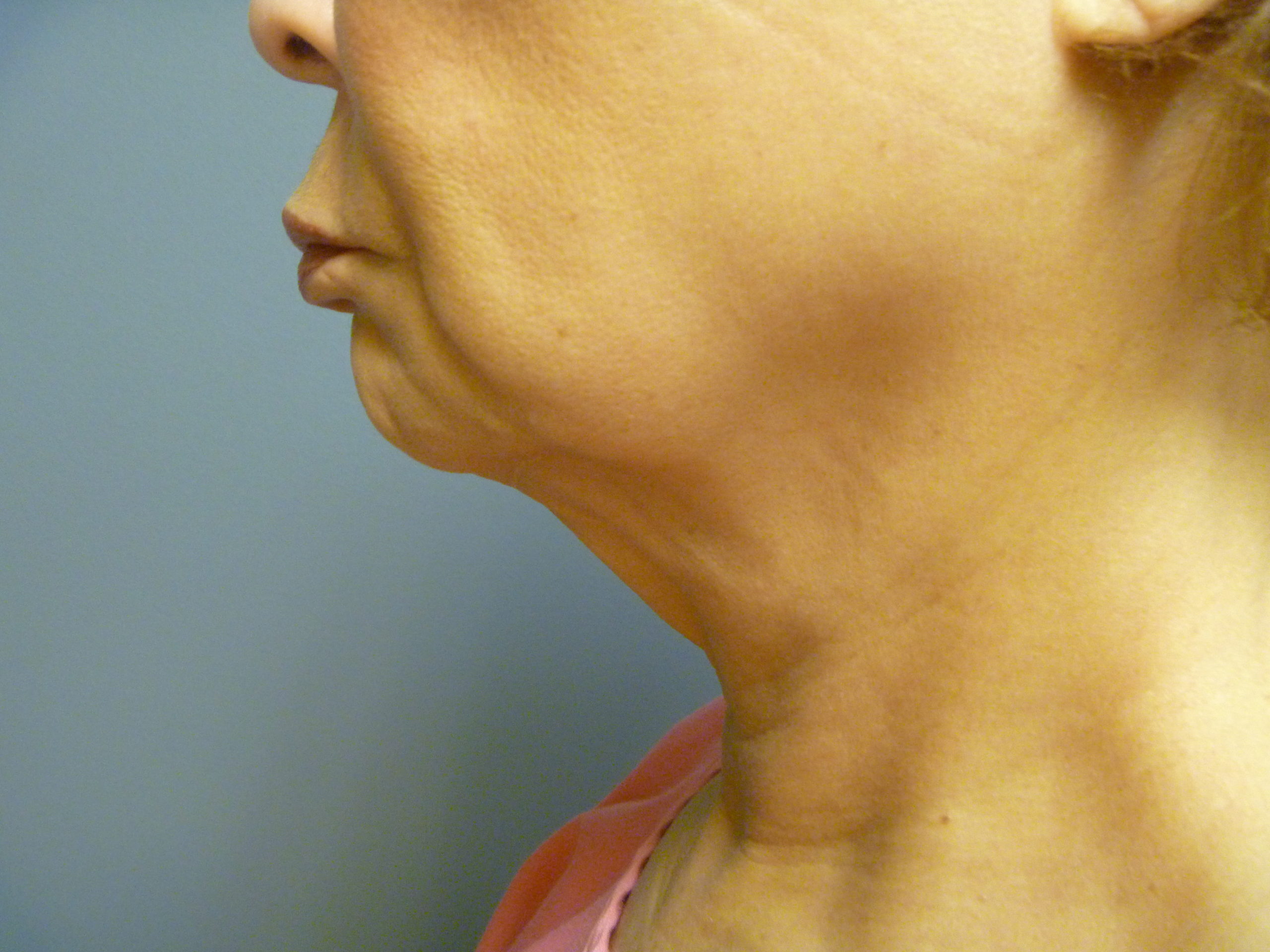 before neck lift