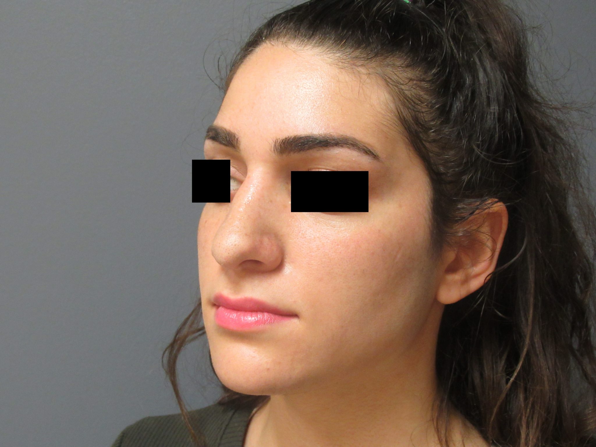 Nose Surgery Aesthetic Plastic Surgery & Laser Center, Michelle