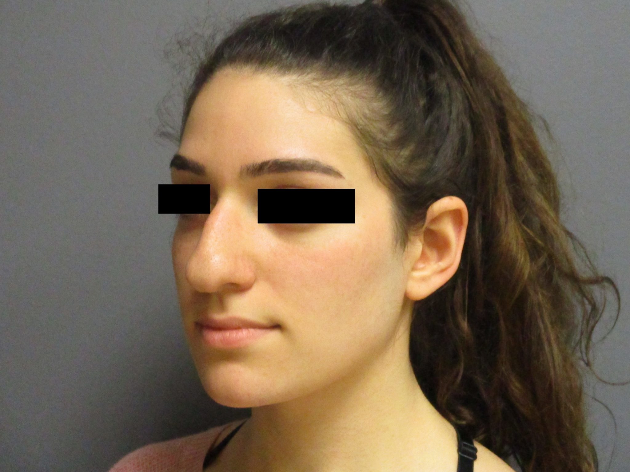 Nose Surgery Aesthetic Plastic Surgery & Laser Center, Michelle