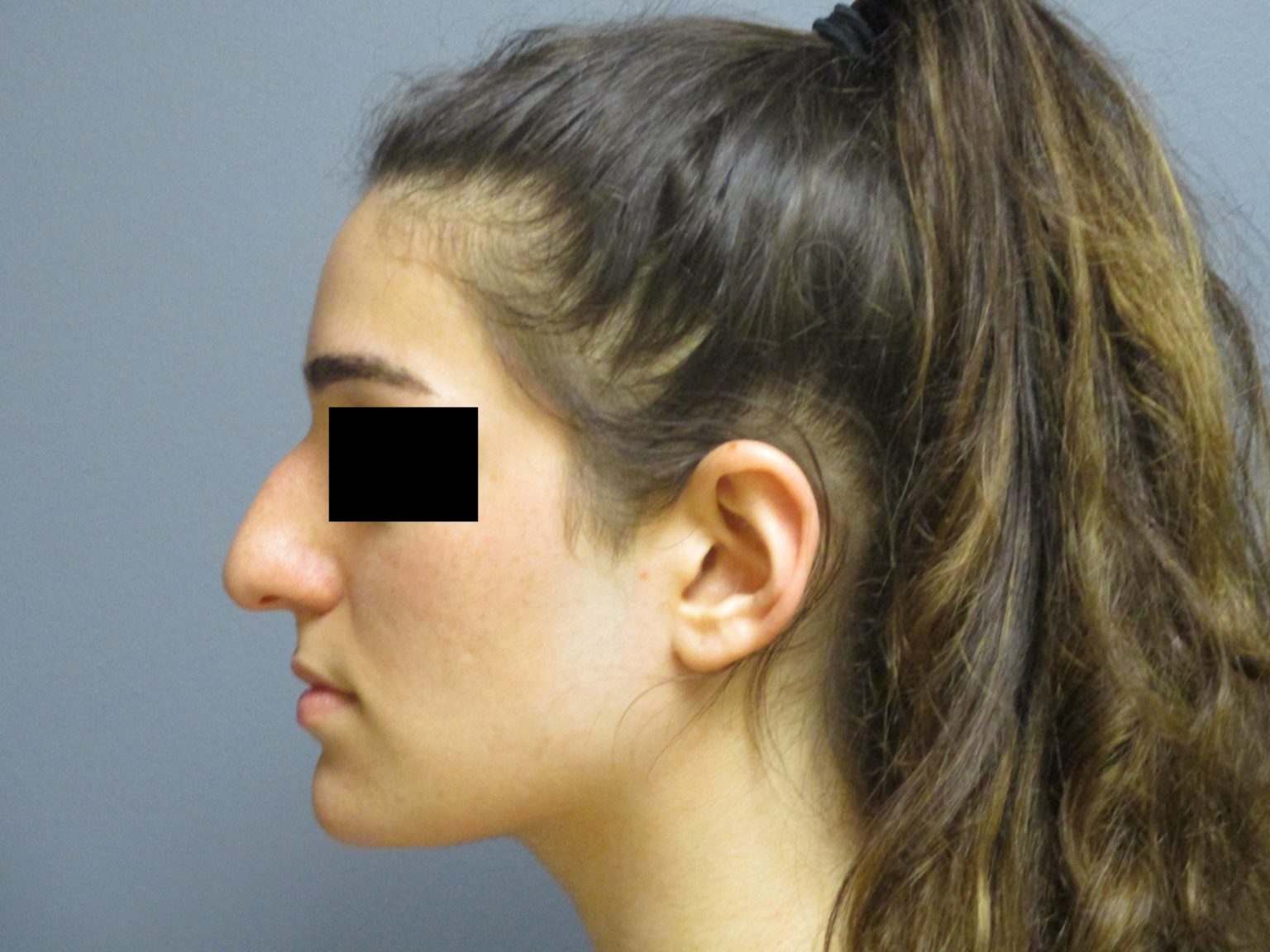 Nose Surgery Aesthetic Plastic Surgery & Laser Center, Michelle