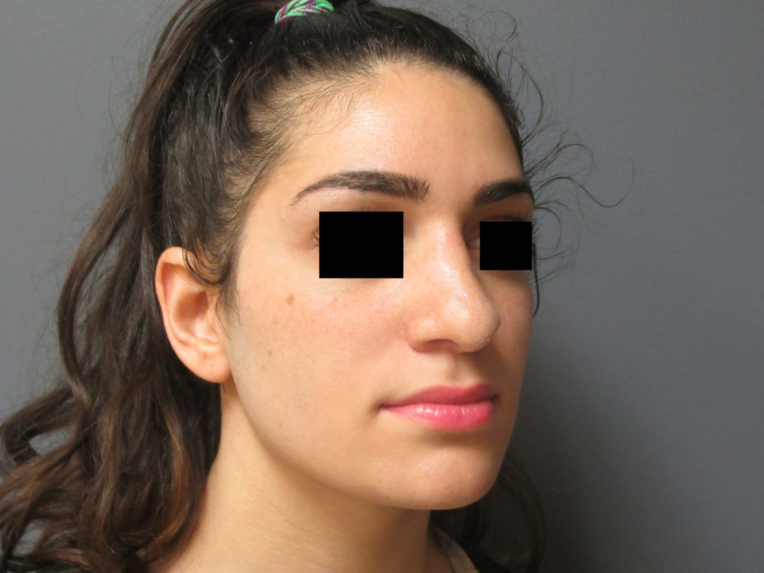 Nose Surgery Aesthetic Plastic Surgery & Laser Center, Michelle