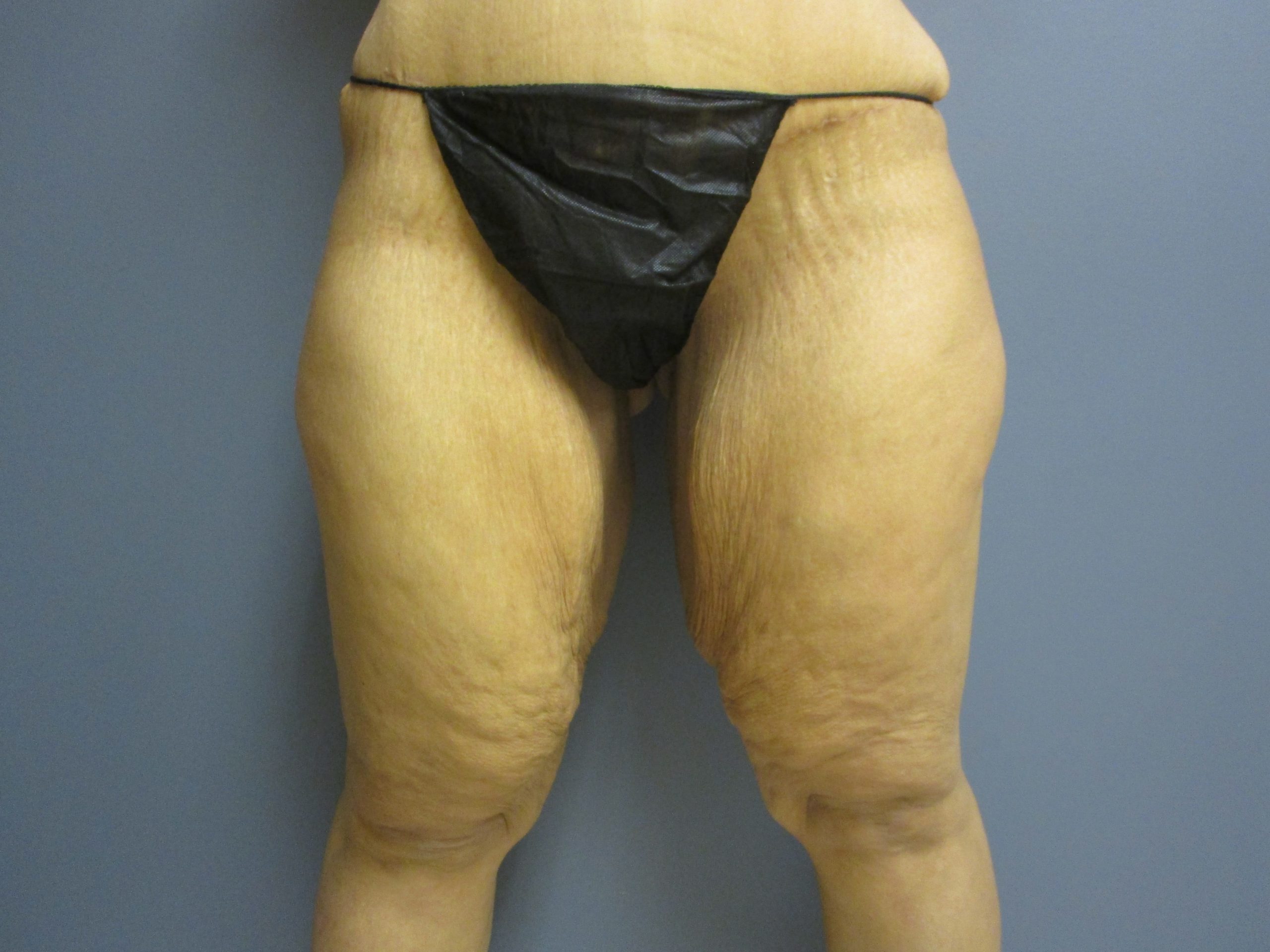 before 33 yr old female 5'10 223 lbs Before Medial Thigh Lift
