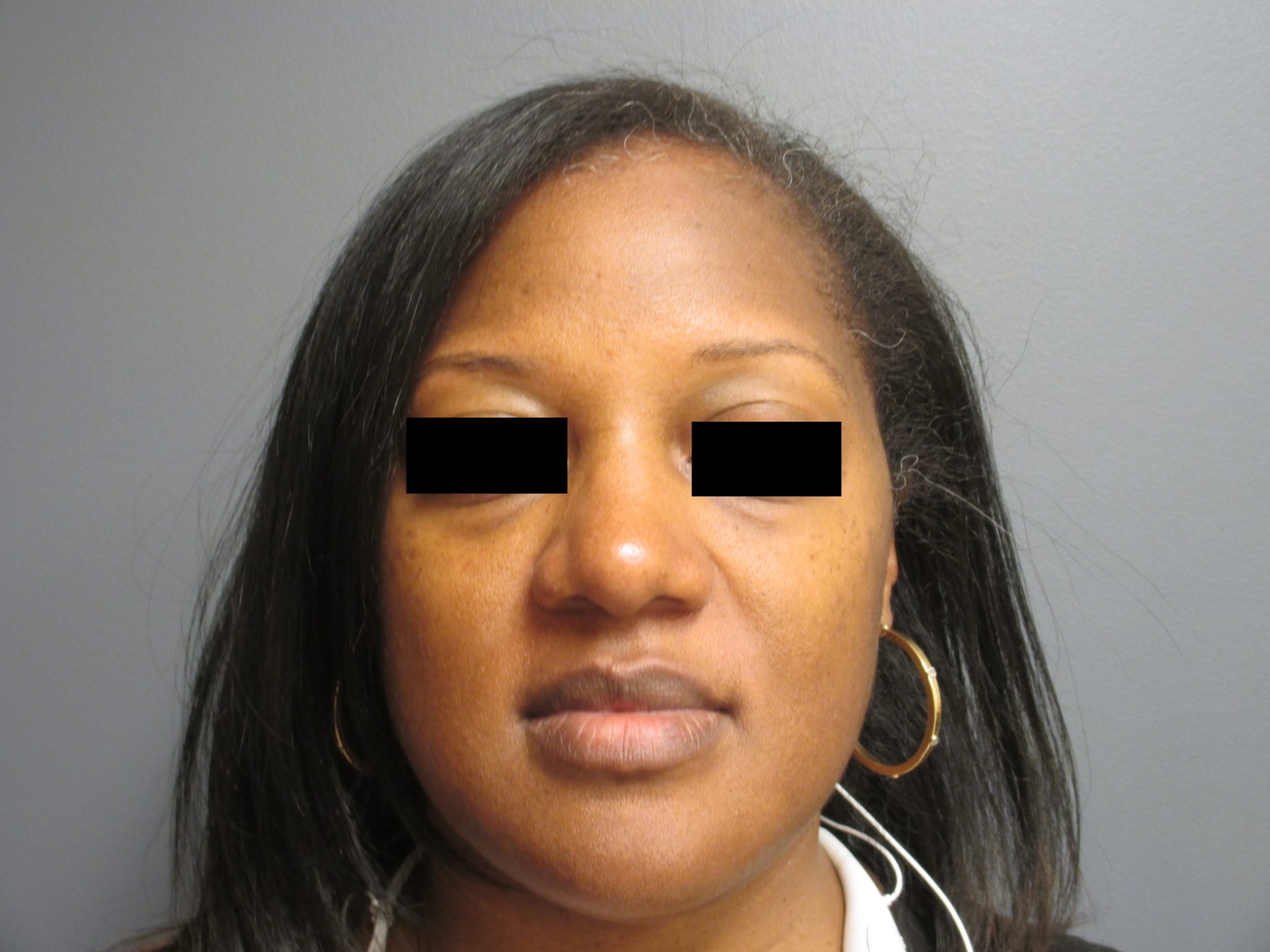 Nose Surgery Aesthetic Plastic Surgery & Laser Center, Michelle