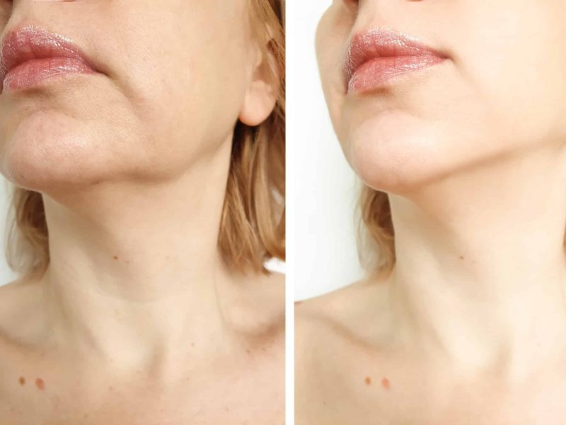 woman tightening the chin before and after the procedure