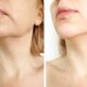 woman tightening the chin before and after the procedure