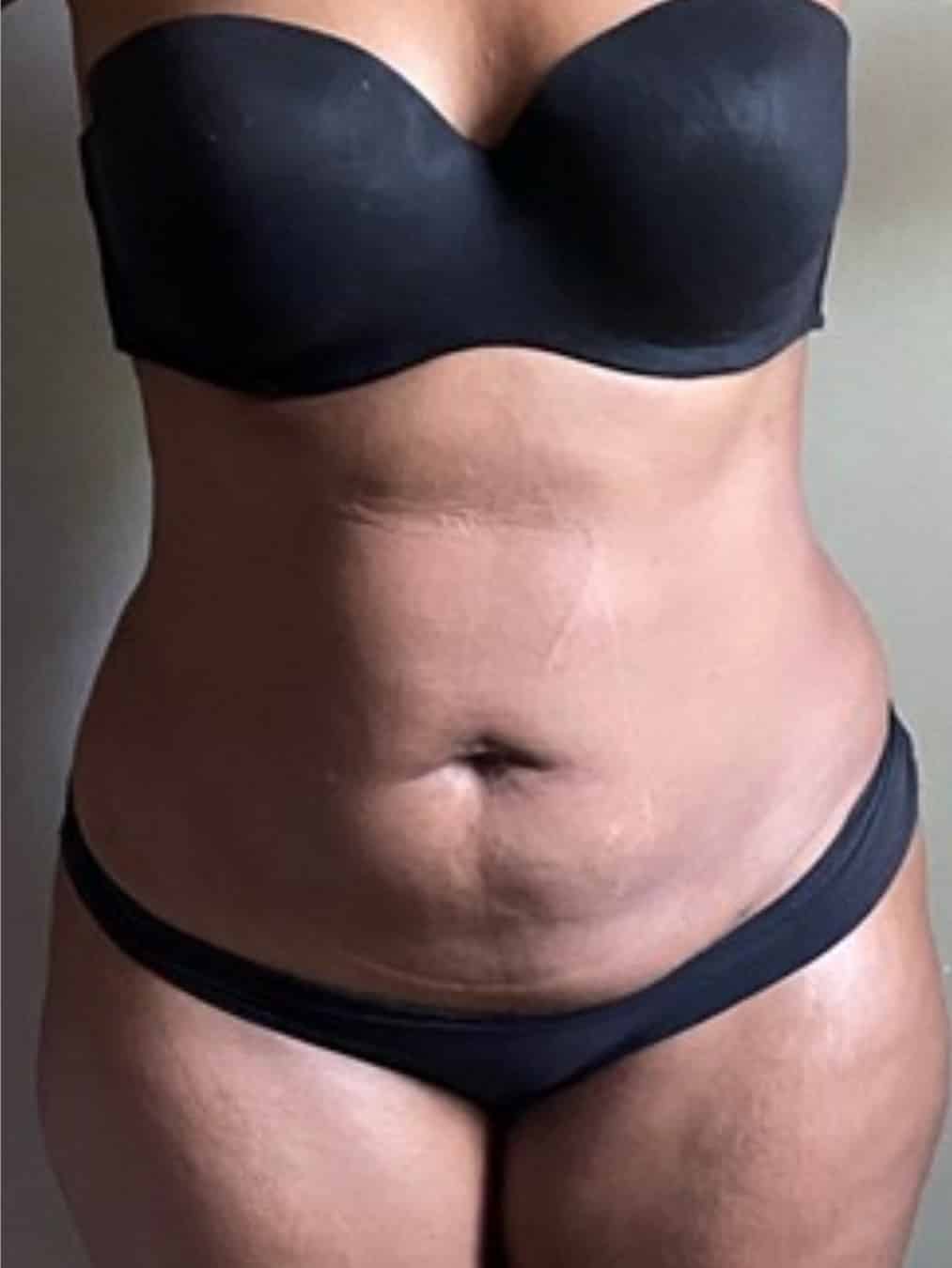 41-year-old-female-3-months-post-op-vaseer-liposuction-of-the-back