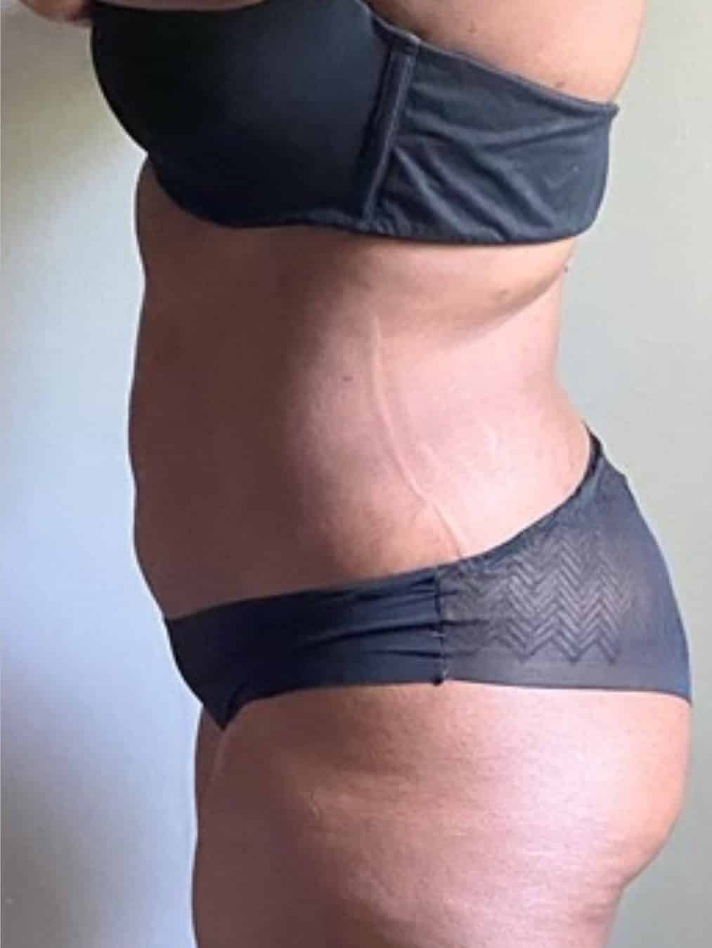 41-year-old-female-3-months-post-op-vaseer-liposuction-of-the-back
