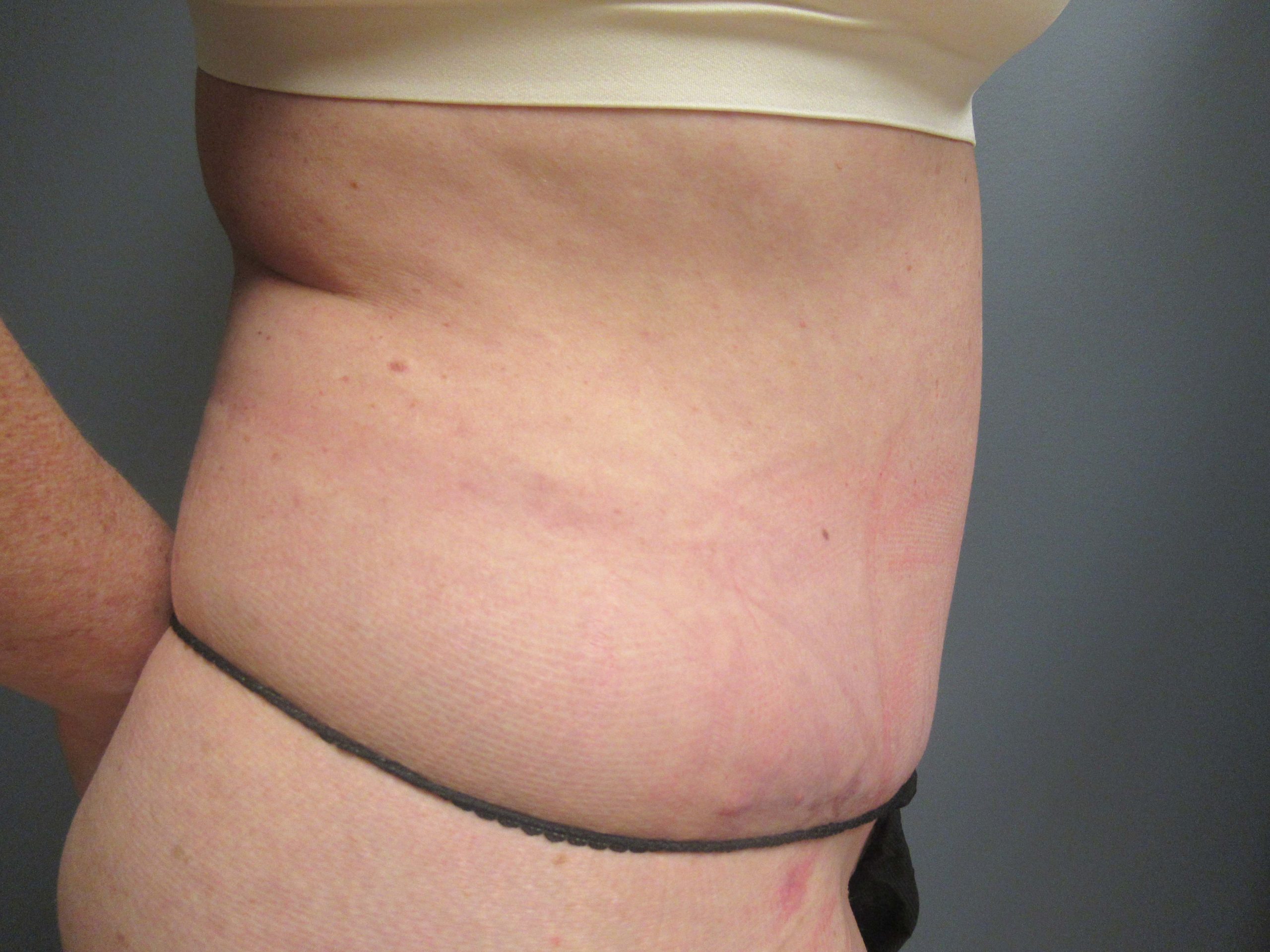 53-yr-old-female-55-209-lbs-3-months-After-Tummy-Tuck-Side