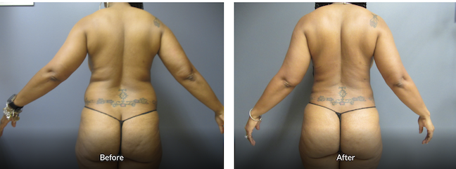 before and after vaser liposuction surgery
