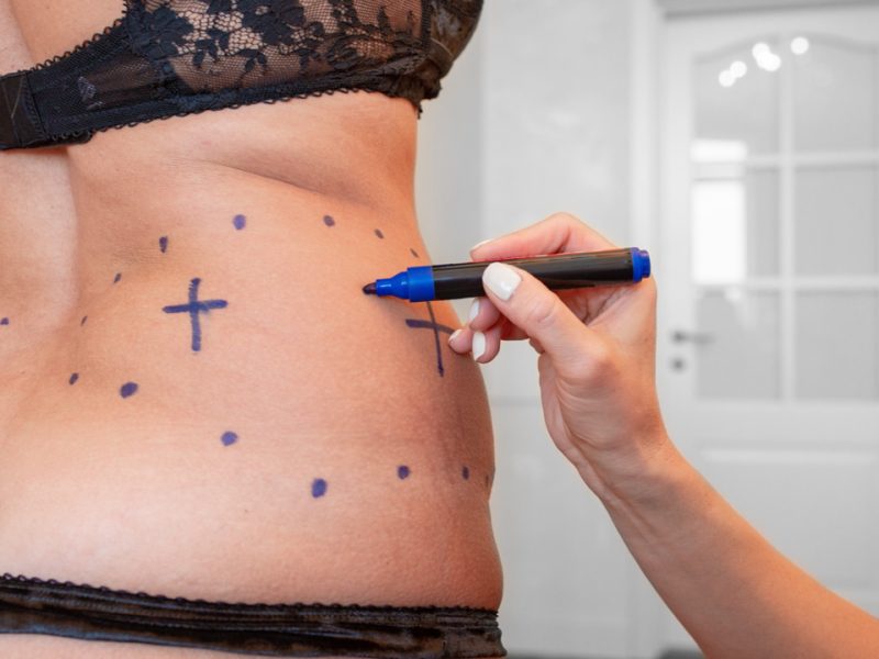 surgeon preparing woman for liposuction surgery