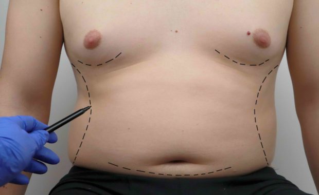 male tummy tuck