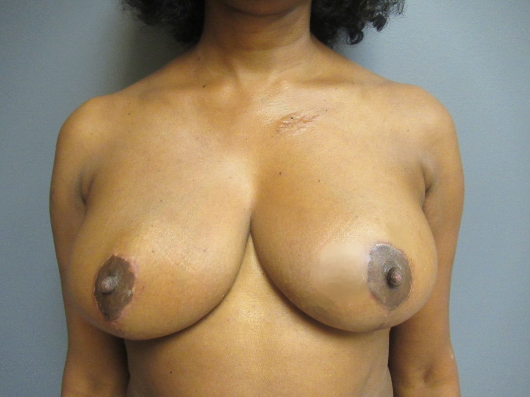 after breast reduction