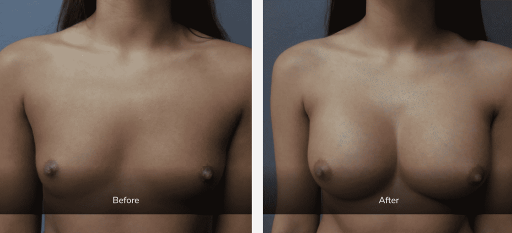 before and after breast augmentation photos