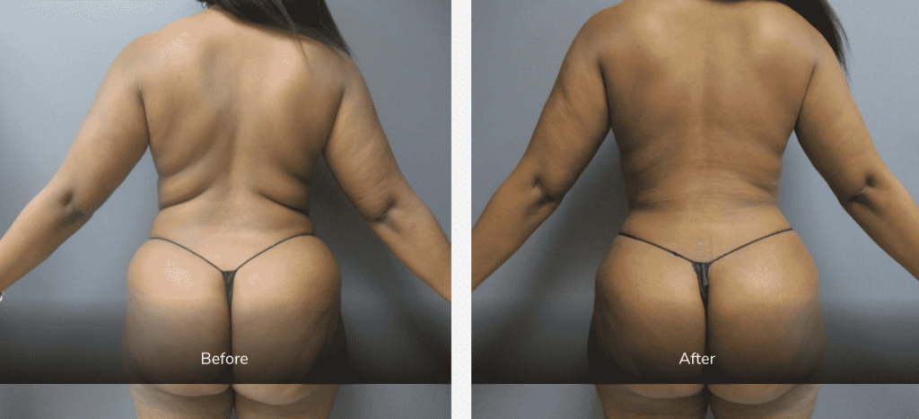 body contouring surgery before and after Liposuction Gallery