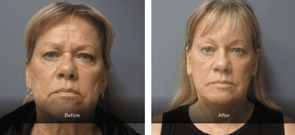 before and after facial enhancement gallery