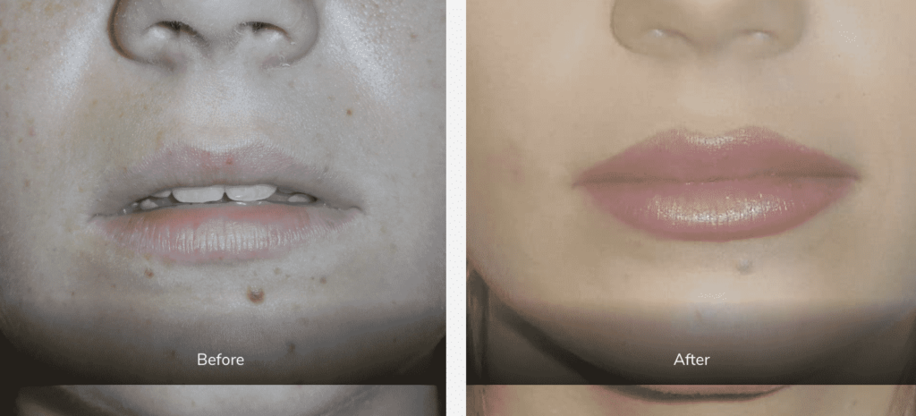 before and after dermal fillers gallery