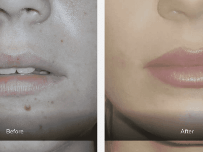 before and after dermal fillers gallery