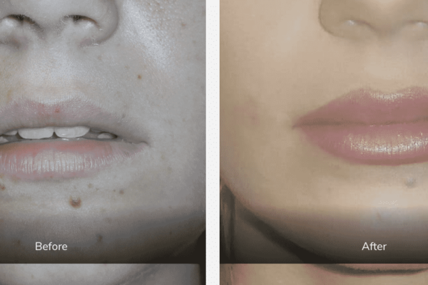before and after dermal fillers gallery